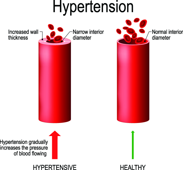 blood-pressure-graphic.jpg